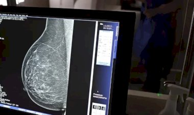 Paraíba recebe medicamento inédito para câncer de mama no SUS